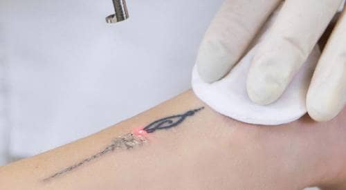 Laser Tattoo Removal -